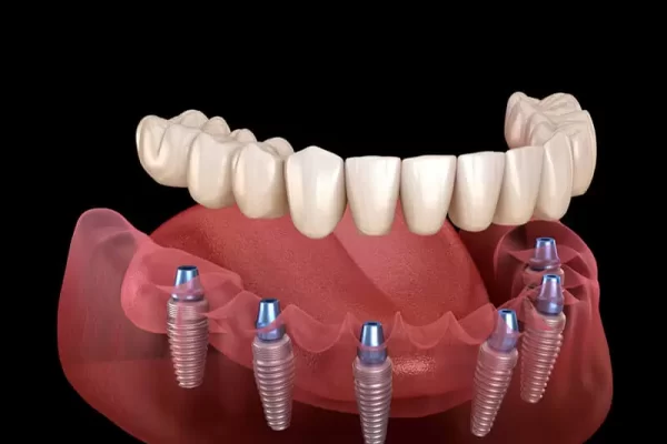 cirurgia-de-implantes-ok