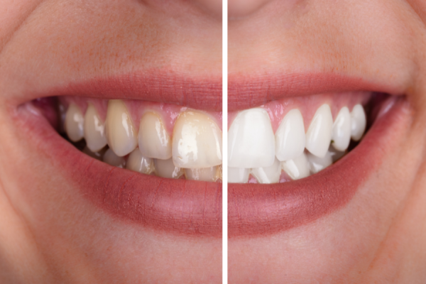 clareamento-dental