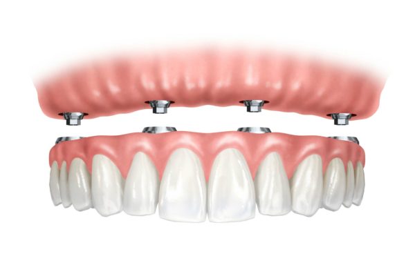 sobre-implates-dentales